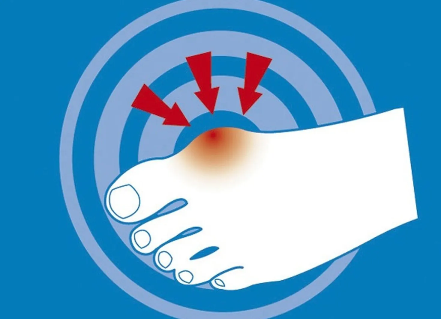 epitact Epithelium 26® Hallux valgus-Schutz